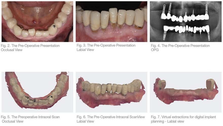 Teeth scans of an 85-year-old man