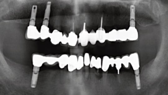 Failed lower dentition and very old steriosis implants